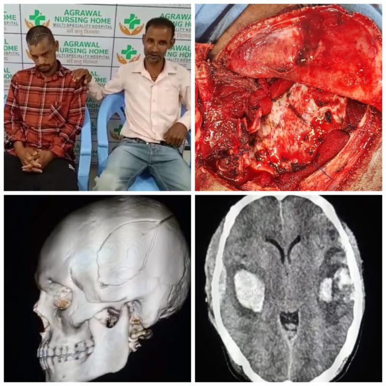 बसना – सड़क दुर्घटना में घायल मरीज के सिर में गंभीर चोट जिसका अग्रवाल नर्सिंग होम बसना में हुआ जटिल ब्रेन सर्जरी |