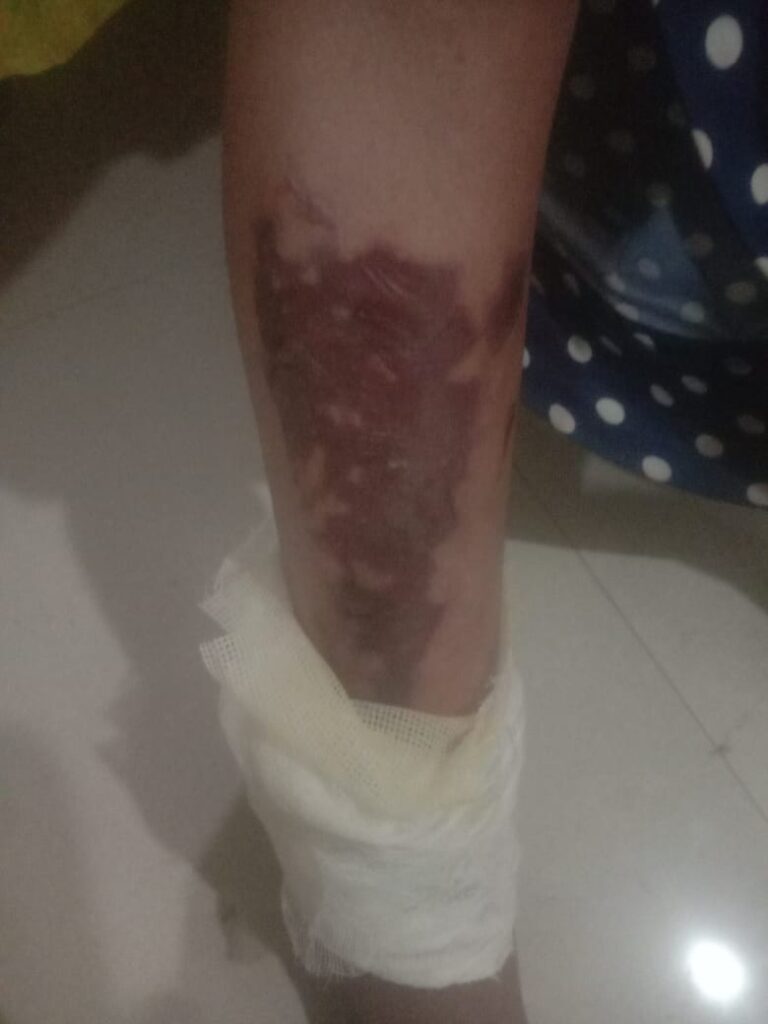 सरायपाली के इस निजी अस्पताल में  जरा भी मानवता नही डिलीवरी के बाद ICU में लापरवाही इलाज के दौरान महिला का पैर जल गया लेकिन गरीब के उपचार के लिए कुछ नही किया अस्पताल प्रबंधन ने ?