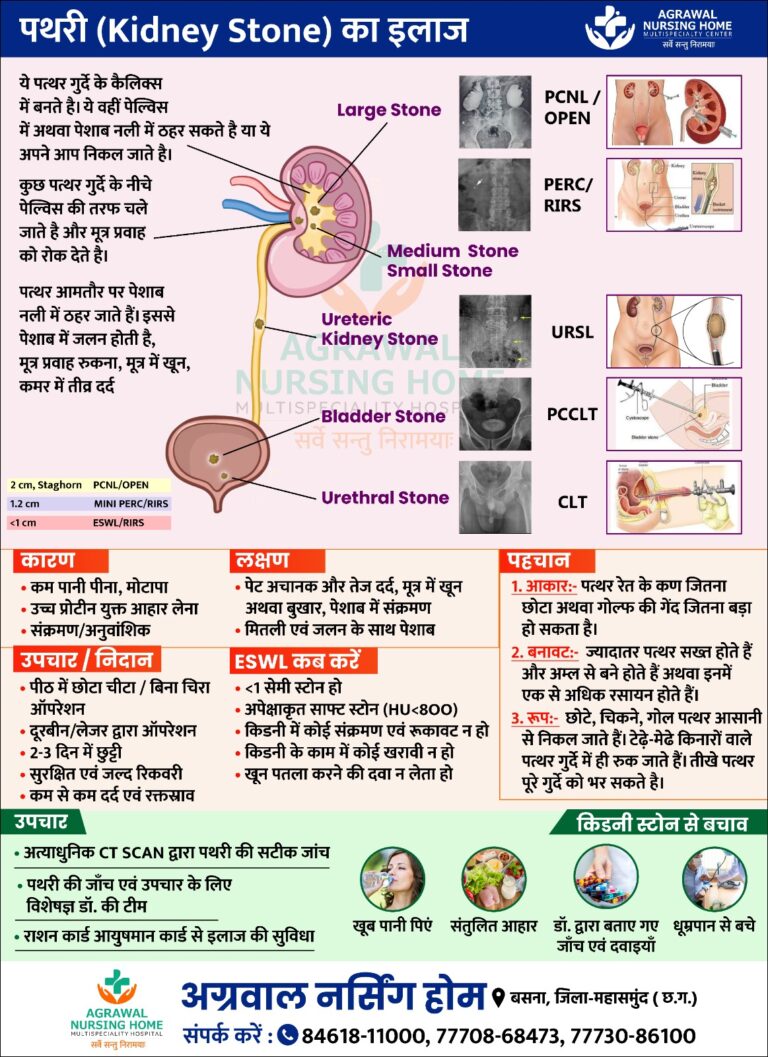 बसना : अग्रवाल नर्सिंग होम बसना में पथरी (Kidney Stone) का इलाज जानिए लक्षण चिकित्सकों द्वारा उपचार